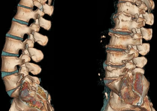 dyskopatia