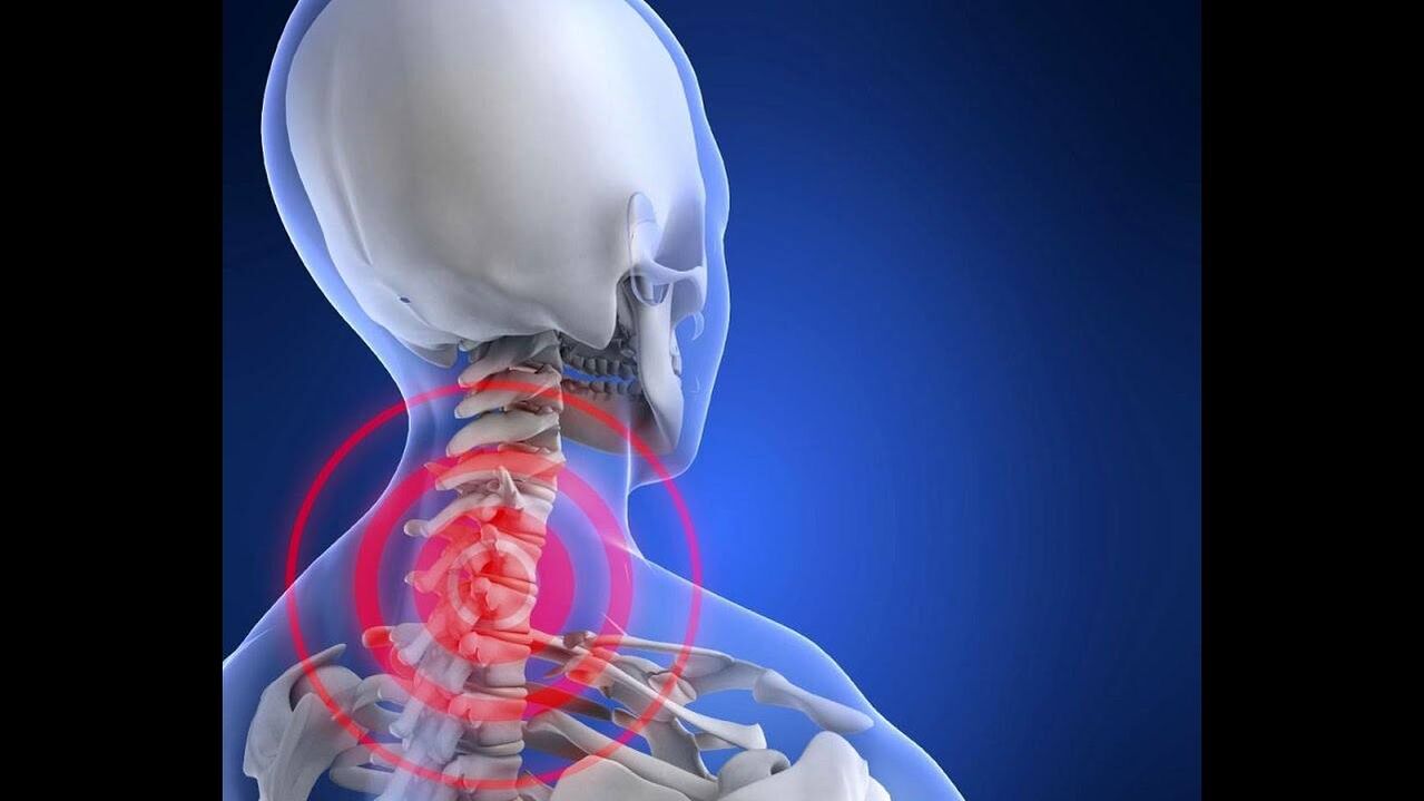 Osteochondroza kręgosłupa szyjnego