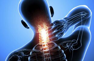 Osteochondroza szyjki macicy