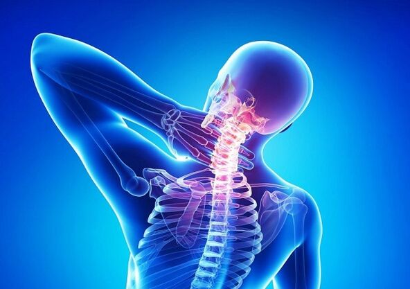 ból kręgosłupa szyjnego z osteochondrozą