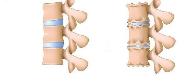 zdrowy kręgosłup i osteochondroza