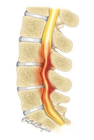 W przypadku osteochondrozy kręgosłupa piersiowego dochodzi do ucisku kanału kręgowego