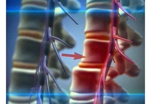 Ściskanie zakończeń nerwowych w osteochondrozie lędźwiowej