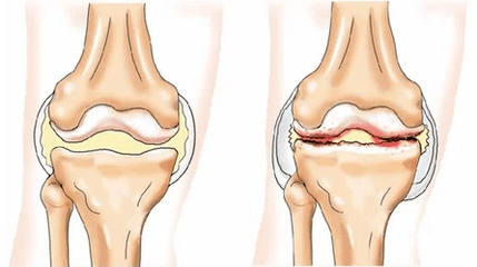 Chondromatoza