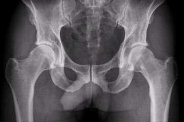 Opcje diagnostyczne artrozy stawu biodrowego
