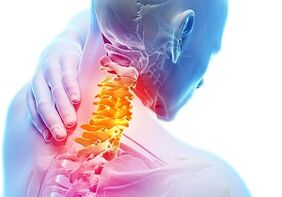 Główne objawy osteochondrozy szyjki macicy