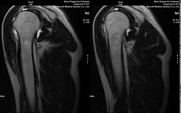 prześwietlenie w celu zdiagnozowania artrozy barku