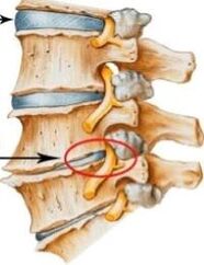 osteochondroza odcinka szyjnego kręgosłupa
