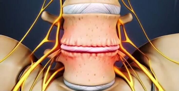 zmiany kręgosłupa spowodowane osteochondrozą
